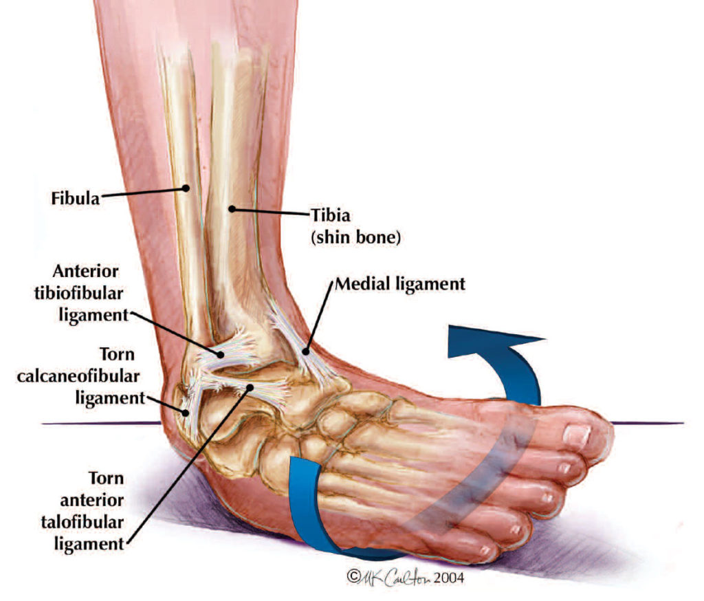 Ankle Fractures - Advanced Foot & Ankle Care Specialists